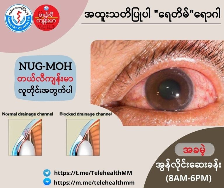 ရေတိမ် Glaucoma ( July, 2022 )