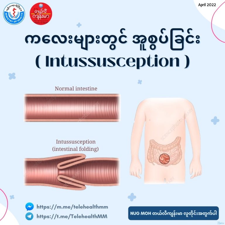 ကလေးအူစွပ်ခြင်း Childhood Intussusception ( April, 2022 )