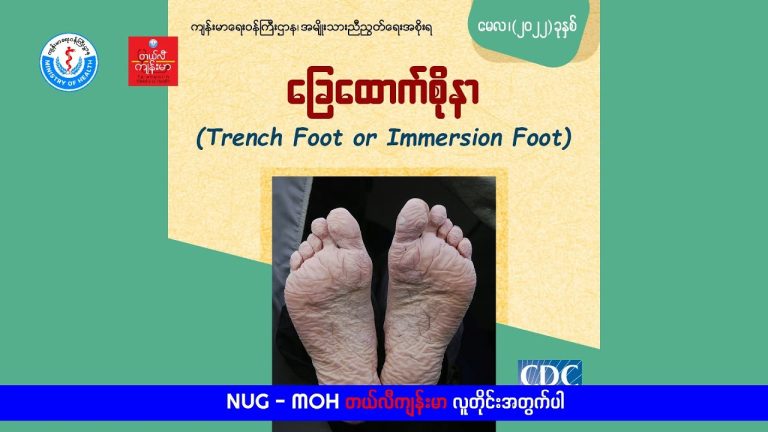 ခြေထောက်စိုနာ Trench Foot or Immersion Foot (Video)